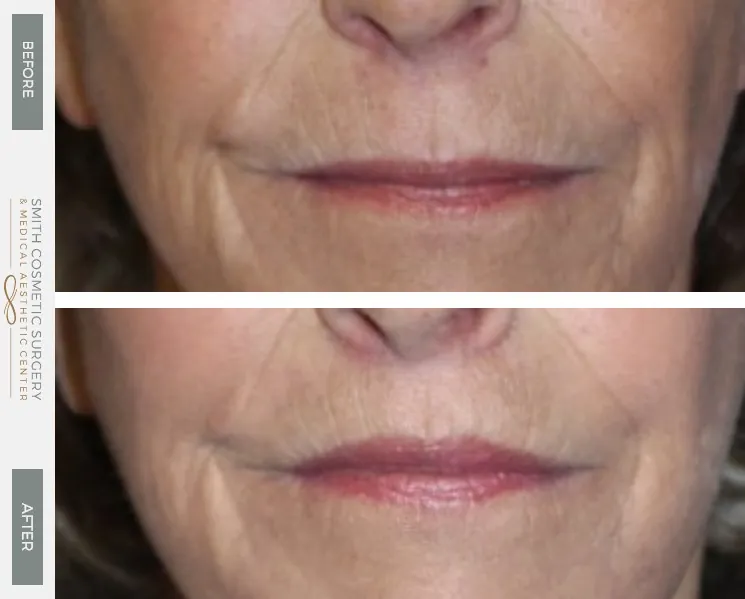 lip_lift_before_and_after.jpg