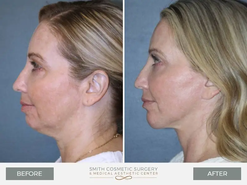 01_deep_neck_lift_before_and_after.jpg