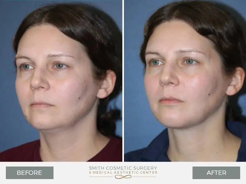 03_deep_neck_lift_before_and_after.jpg